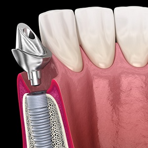 A 3D illustration of a dental implant abutment