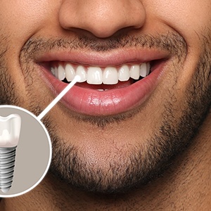 A photo highlighting a man’s complete dental implant