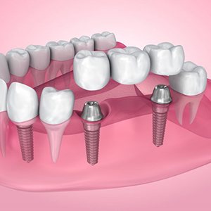 Exploded illustration of dental implants with bridge and crown